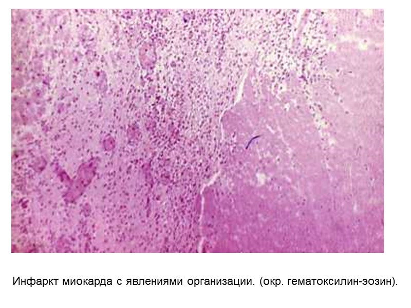 Инфаркт миокарда с явлениями организации. (окр. гематоксилин-эозин).